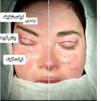 مدل جراحی لیفت شقیقه - ابرو - صورت- سانترال لب