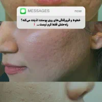 آخرین تخفیف ژل و فیلر، بوتاکس، مزوتراپی، پی آرپی|خدمات آرایشگری و زیبایی|آق قلا, |دیوار