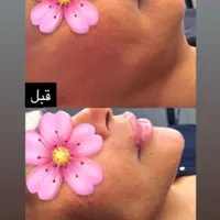 تخفیفات ژل و بوتاکس کلینیک آقایان و خانم ها تا|خدمات آرایشگری و زیبایی|شاهین‌شهر, فردوسی|دیوار