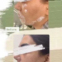 تزریق ژل وبوتاکس با منطقی ترین قیمت و بهترین کیفیت