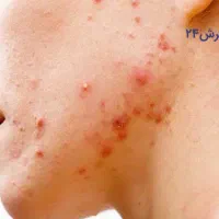 راهنمایی کنید دکتر پوست جوش صورت