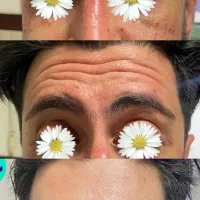 بوتاکس/پی آر پی/ژل لب/لیزر /مسکن|خدمات آرایشگری و زیبایی|کرمانشاه, |دیوار