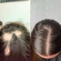 درمان ریزش مو رفع شوره ریزش سکه ای رویش مجدد