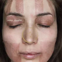 خالبرداری و پلکسرتراپی صورت و بدن،پاک کردن تتو