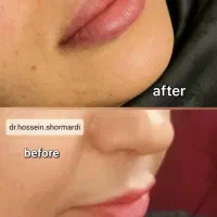 تزریق بوتاکس تخصصی توسط پزشک