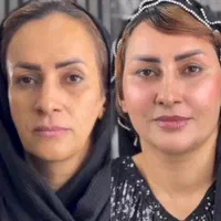 لیفت و جوانسازی صورت با ارزان ترین قیمت توسط پزشک|خدمات آرایشگری و زیبایی|مشهد, هنرستان|دیوار