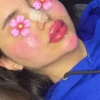 ژل و بوتاکس فقط ۳۹۰