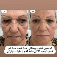 لیزر موهای زائد و الکترولیز|خدمات آرایشگری و زیبایی|فولادشهر, B5|دیوار