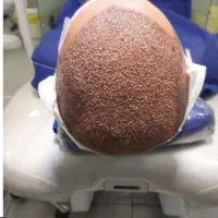 کاشت مو با بالا ترین تراکم و نازلترین قیمت|خدمات آرایشگری و زیبایی|تبریز, |دیوار