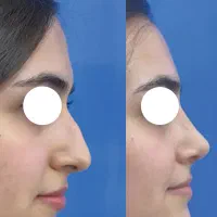 جراحی زیبایی بینی ، پلک ، شکم (اقساطی)