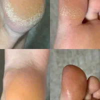 کفسابی پا.درمان ناخن پا.میخچه. ارتونیل ناخن پا|خدمات آرایشگری و زیبایی|کرج, کوی امامیه|دیوار