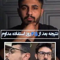 درمان کم‌پشتی ریش/ریزش مو/ریزش سکه‌ای/رویش مو