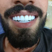 انجام کامپوزیت ونیر با بهترین متریال با افر ۶۰٪|خدمات آرایشگری و زیبایی|بابل, |دیوار