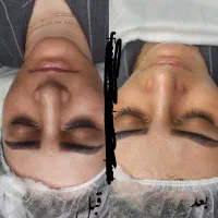 فشیال و پاکسازی تخصصی پوست