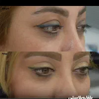 کاشت مو/زیبایی/ ضمانت کتبی/پزشک متخصص/اقساط|خدمات آرایشگری و زیبایی|پاکدشت, پاکدشت (مامازند)|دیوار