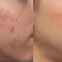 فرمول سفید کننده فوق العاده قوی دست و پا