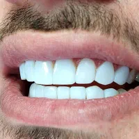 کامپوزیت زیبایی