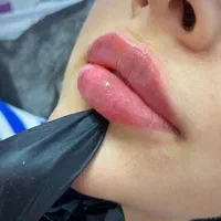 ژل هر سی سی ۵۵۰/بوتاکس ۶۰۰/و مزوتراپی ۸۰۰|خدمات آرایشگری و زیبایی|شهریار, شهریار|دیوار