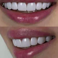 کامپوزیت دندان|خدمات آرایشگری و زیبایی|اردبیل, |دیوار