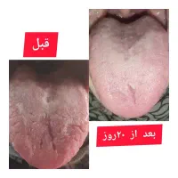 کیست وفیبرم وپاکسازی