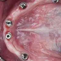 جشنواره تخفیف ایمپلنت در تبریز،با روکش فقط ۱۶تومن|خدمات آرایشگری و زیبایی|خوی, |دیوار