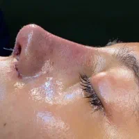 تخفیف ویژه جراحی بینی در اردیبهشت ماه