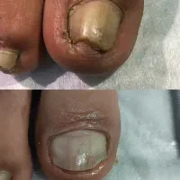 اصلاح فرم ناخن فرورفته درگوشت.ارتونیل پدیکوردرمانی