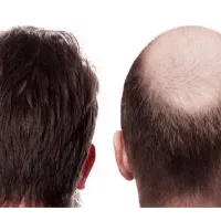 مطب متخصص آماده جهت کاشت مو ولیزر