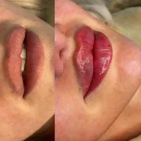 لیفت،لیزر مو زائد،تزریق ژل390،بوتاکس هایفو کلینیک