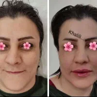 تزریق چربی ، فیلر بادی، ژل، بوتاکس در مطب|خدمات آرایشگری و زیبایی|شیراز, گویم|دیوار