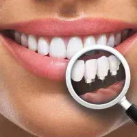 ایمپلنت کره ای با روکش 12/600تومان بدون درد