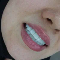 کامپوزیت زیبایی دندان پزشکی|خدمات آرایشگری و زیبایی|یاسوج, |دیوار