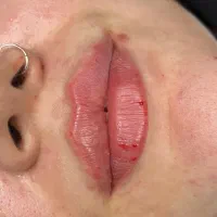 فیلر بوتاکس توسط پزشک زیبایی