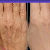 الکترولیز موی سفید و خال بردای|آرایشی، بهداشتی، درمانی|یاسوج, |دیوار