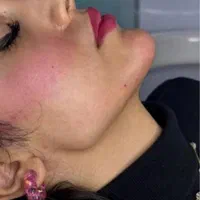 کلینیک تزریق ژل و بوتاکس .فیلر زیر چشم . آنزیم|خدمات آرایشگری و زیبایی|کرج, گوهردشت|دیوار