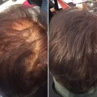 آلوپسی آره آتا چیست