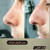 جراحی زیبایی بینی فقط با 22 ملیون|خدمات آرایشگری و زیبایی|شاهرود, |دیوار