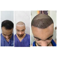 جشنواره پاییزی کاشت مو وابرو|خدمات آرایشگری و زیبایی|رباط‌کریم, رباط‌کریم|دیوار