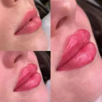 پیکرتراشی و تزریق فیلر و بوتاکس درمطب زیبایی صدرا