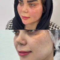 مدل جهت تزریق چربی/انجام بلفاروپلاستی|خدمات زیبایی و سلامت|تهران, شکوفه (عبدل آباد)|دیوار