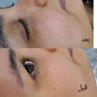 فیشیال و پاکسازی تخصصی پوست|خدمات آرایشگری و زیبایی|قم, قلعه کامکار|دیوار