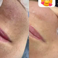 پاکسازی و فیشال پوست|خدمات آرایشگری و زیبایی|میبد, |دیوار