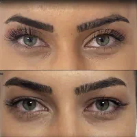 بلفاروپلاستی فقط۴تومان وساکشن غبغب۵تومن