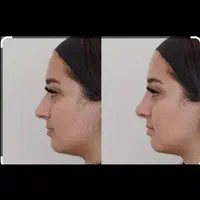 طراحی لیفت بینی وفرمدهی عملی(بدون جراحی)پزشک متخصص|خدمات آرایشگری و زیبایی|مشهد, سناباد|دیوار