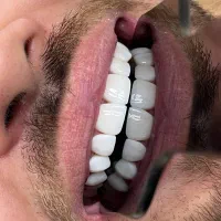 ایمپلنت،کامپوزیت،جرمگیری