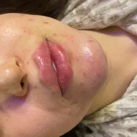 ژل و فلیر بوتاکس فقط 700