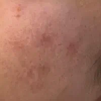 فیشیال پوست