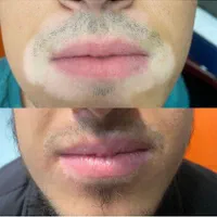 درمان گیاهی بیماری پیسی وپسوریازیس|خدمات آرایشگری و زیبایی|مشهد, حرم مطهر رضوی|دیوار