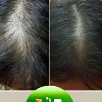 درمان ریشه ای مشکلات ریزش مو