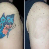 پاک کردن تتو.لیزرکیوسوییچ.PRP.کربن تراپی.روشن سازی|خدمات آرایشگری و زیبایی|اصفهان, سعادتآباد|دیوار